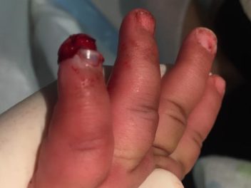 Toddler's pinky cut off